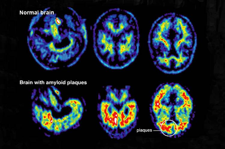 Scans of alzheimers brain compared to normal brain