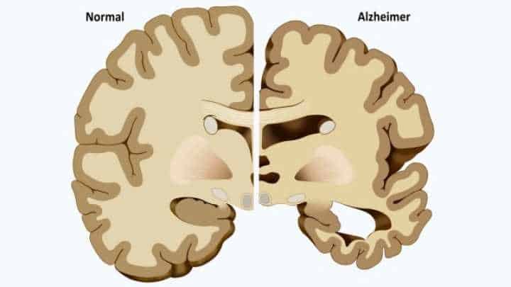 An Alzheimer’s brain next to a larger normal brain